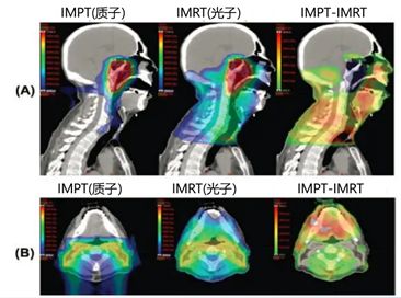 质子治疗和传统放疗治疗鼻咽癌的放射剂量分布对比