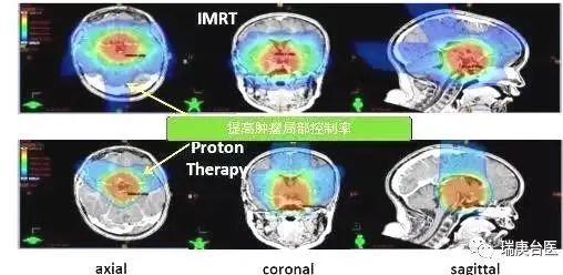 儿童颅咽管瘤质子治疗和传统放疗对比