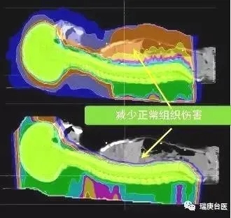 儿童髓母细胞瘤质子治疗和传统放疗对比