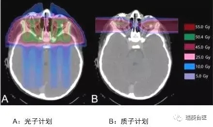 儿童视网膜母细胞瘤质子治疗和传统光子放疗对比