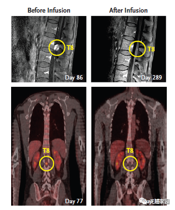 第二轮CAR-T疗法结束后脊索内肿瘤出现剧烈萎缩