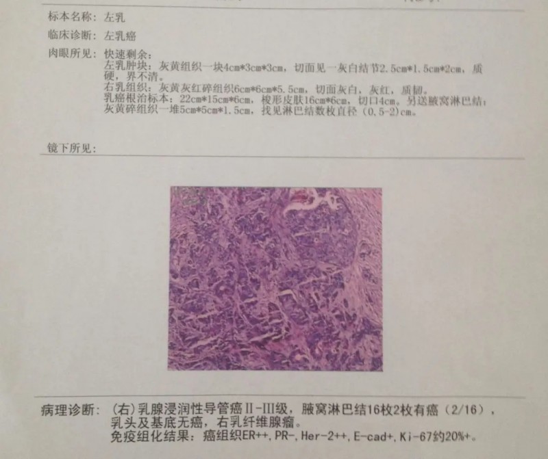 乳腺癌检查报告
