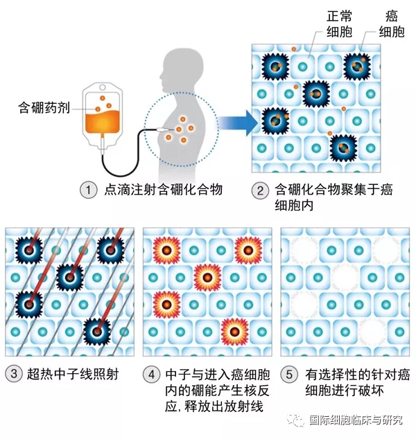 BNCT治疗流程