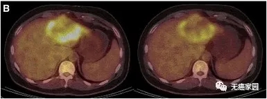 CAR-T细胞免疫疗法治疗结直肠癌患者P9的PET/CT显示肿瘤活性明显减弱