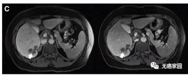 CAR-T细胞免疫治疗结直肠癌通过MRI观察到患者P10的一个肝脏病变发生萎缩
