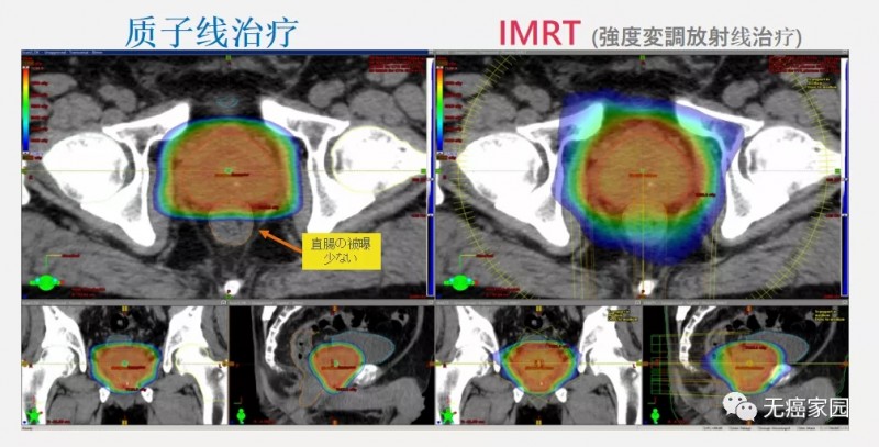 质子治疗前列腺癌前后对比