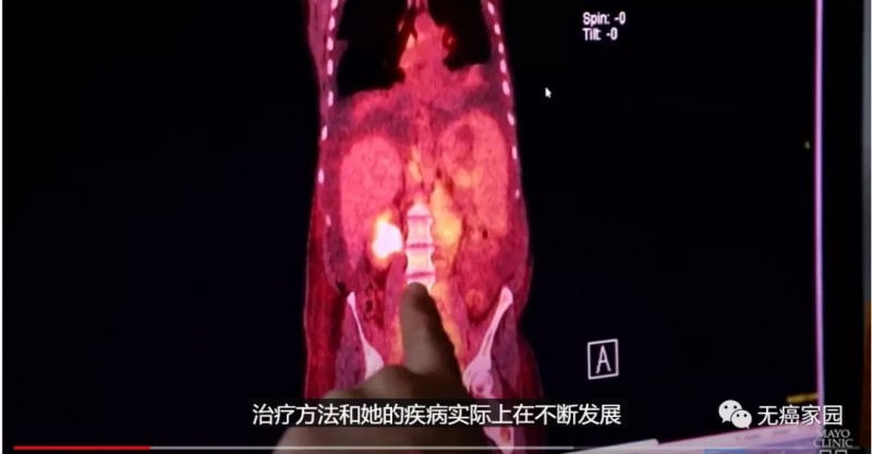 淋巴瘤影像图