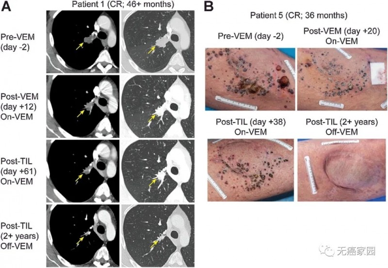 TILs和维莫非尼治疗后达到完全肿瘤消退