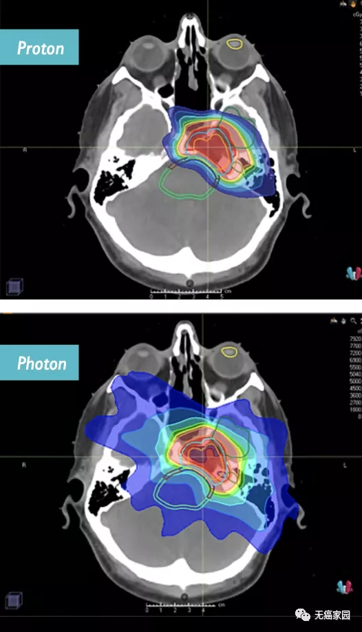 颅底肿瘤质子治疗和传统放疗照射范围的区别
