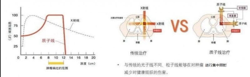 质子治疗和传统放疗对比