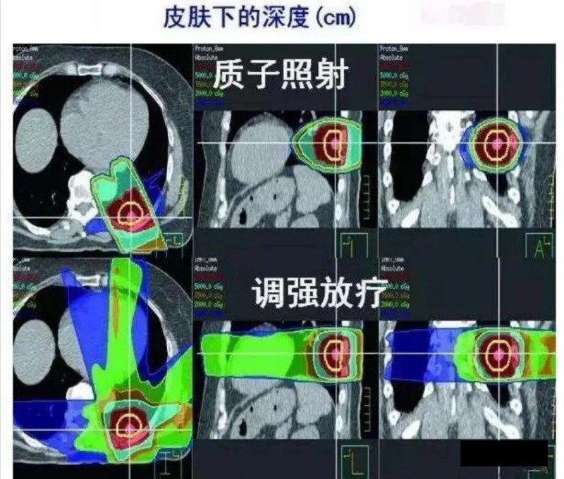 质子治疗和调强放疗照射面积对比