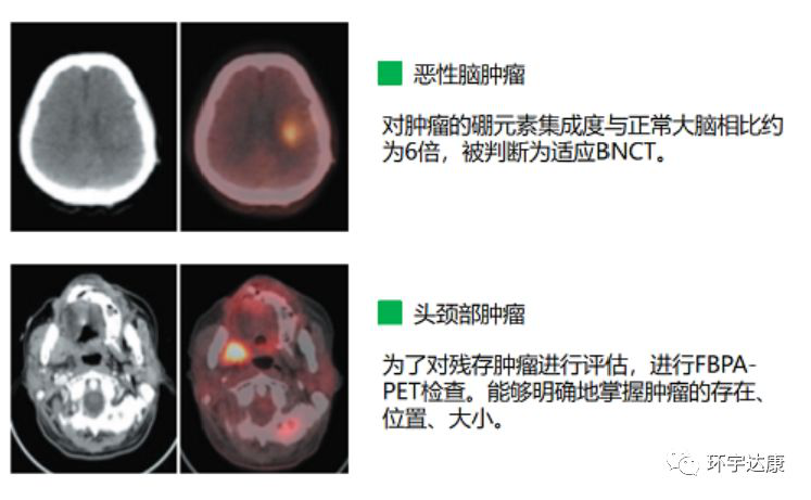 硼中子治疗头颈脑瘤的效果