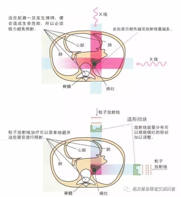 质子刀治疗的优势