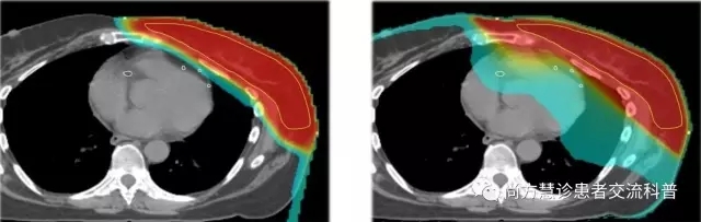 乳腺癌质子放了和传统放疗辐射区域对比