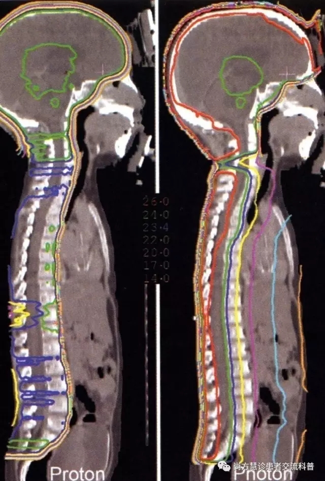 儿童肿瘤全脑全脊照射质子方盒和光子放疗对比