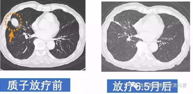 质子治疗肺腺癌前后对比