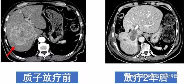 质子放疗治疗肝癌前后对比