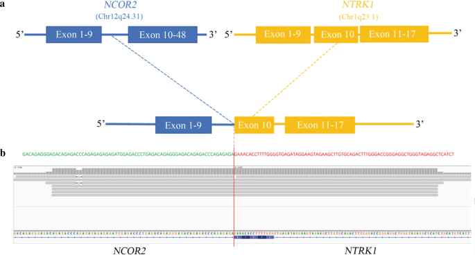 NCOR2-NTRK1融合