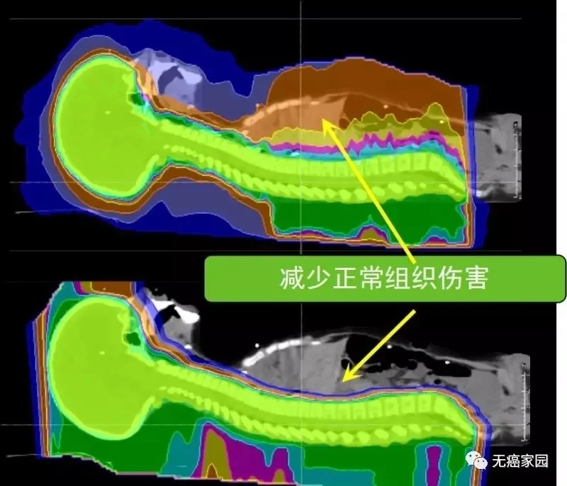 脊索瘤质子放射治疗和传统X线放疗照射范围对比