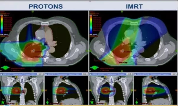 中央型肺癌质子治疗和其他放疗对比