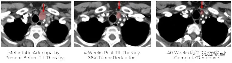 TIL细胞治疗肺癌前后对比