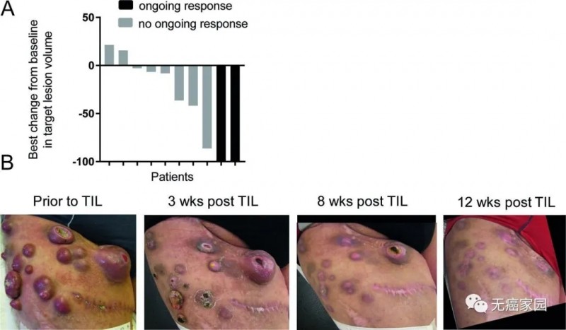 TIL细胞治疗乳腺黑色素瘤前后对比