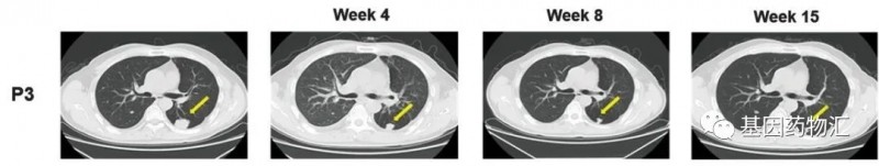CAR-GPC3 T细胞免疫疗法治疗肝癌前后对比