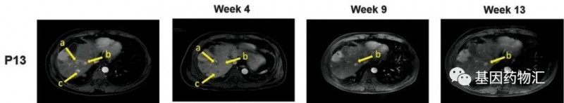 CAR-GPC3 T细胞免疫疗法治疗肝癌前后对比