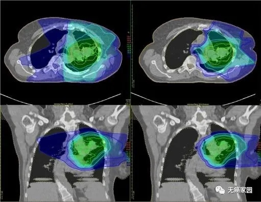 质子治疗和传统放疗照射面积对比