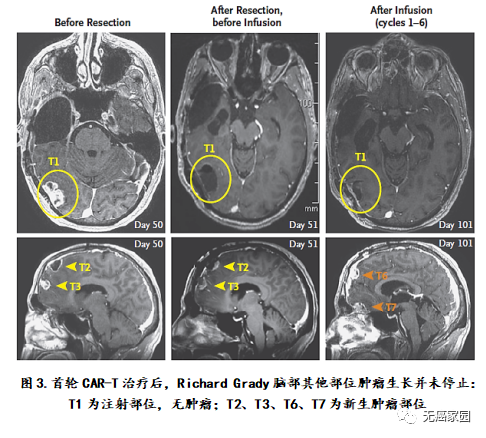 CAR-T疗法治疗脑胶质瘤首次治疗效果对比