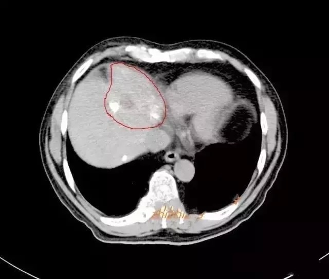 肝癌影像图