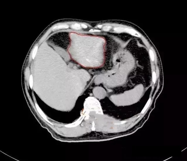 肝癌影像图