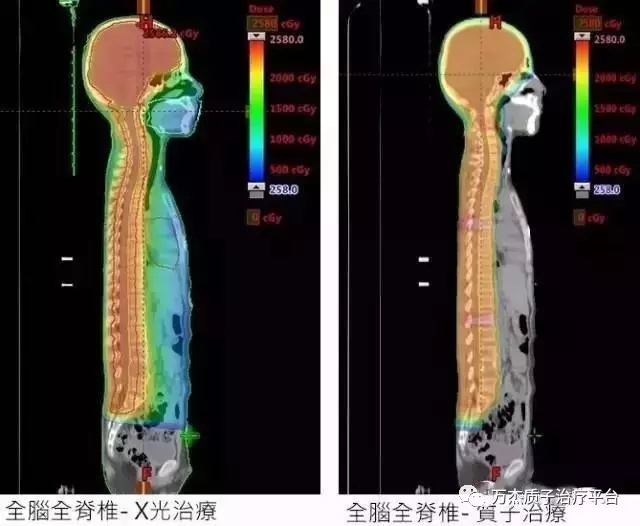 X光全脑全脊照射和质子全脑全脊照射对比