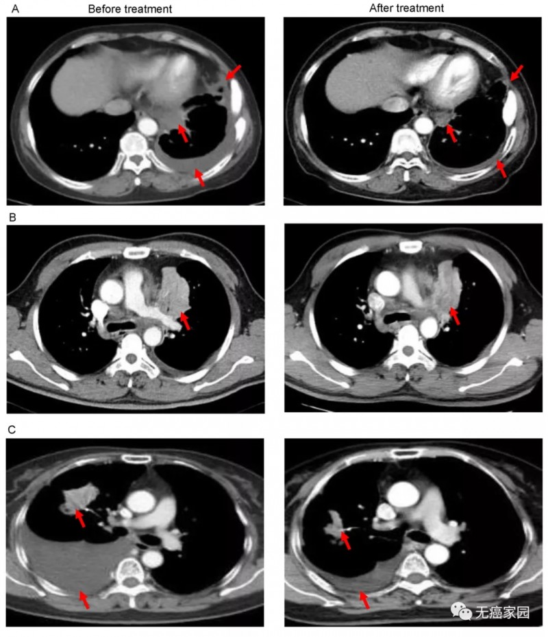 EGFR为靶点的CAR-T治疗晚期难治性非小细胞肺癌前后对比