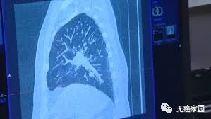 TIL疗法治疗后的肺癌影像图