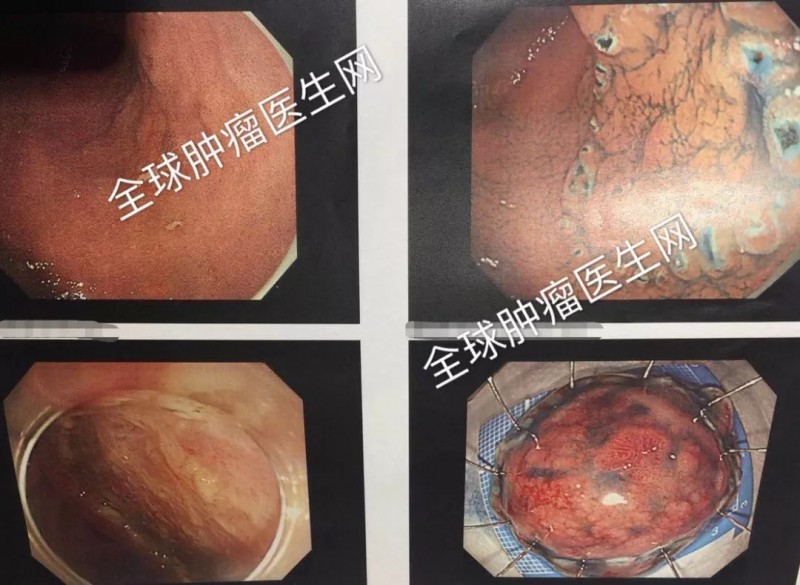 日本治疗胃癌有哪些优势