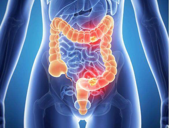 17种有益肠道健康的益生菌食品