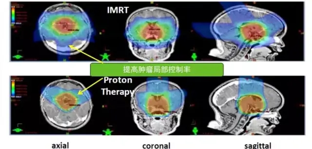 脑瘤传统X线放疗和质子治疗放射面积对比