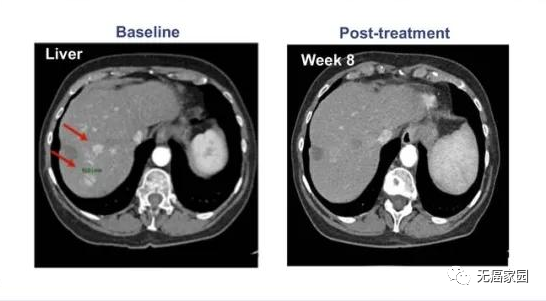 TCR-T细胞免疫疗法治疗肝癌前后对比