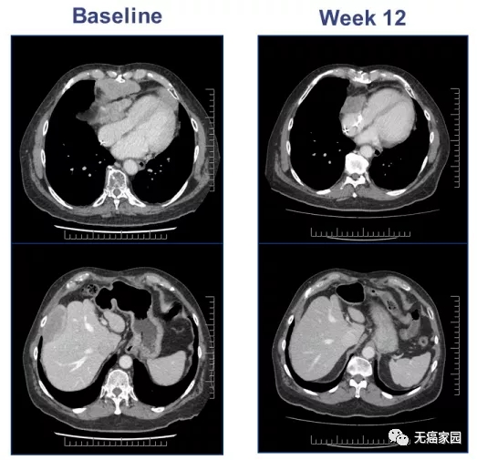 ADP-A2M4治疗老年滑膜肉瘤患者前后对比