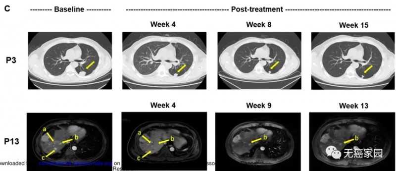 CAR-T细胞免疫治疗肝癌前后对比