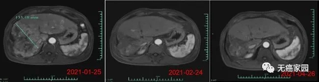 CAR-T细胞免疫疗法受试者012的MRI结果示意图