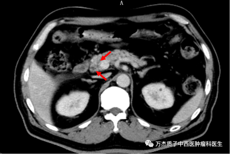 胰腺癌病灶CT图