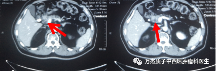 质子治疗胰腺癌半年后复查CT影像图