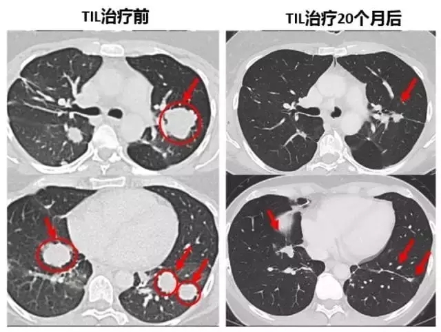 tils疗法治疗胰腺癌肺转移前后对比
