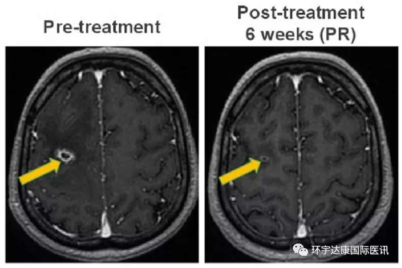 DS-6051b治疗脑转移的效果