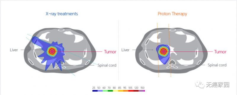 X射线与质子疗法治疗肝癌的比较