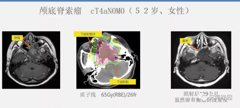 颅低脊索瘤质子治疗