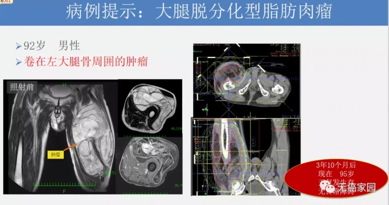 大腿脱分化性脂肪肉瘤质子治疗