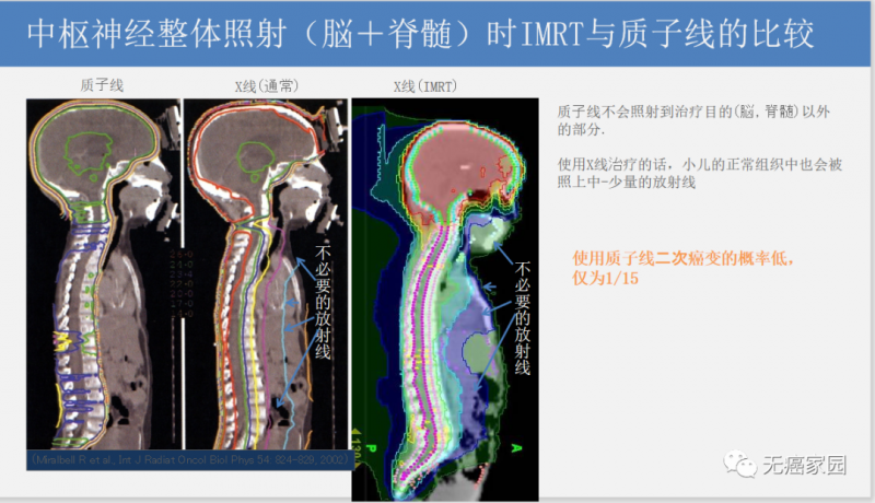 脑瘤和脊髓瘤质子治疗和IMRT治疗对比